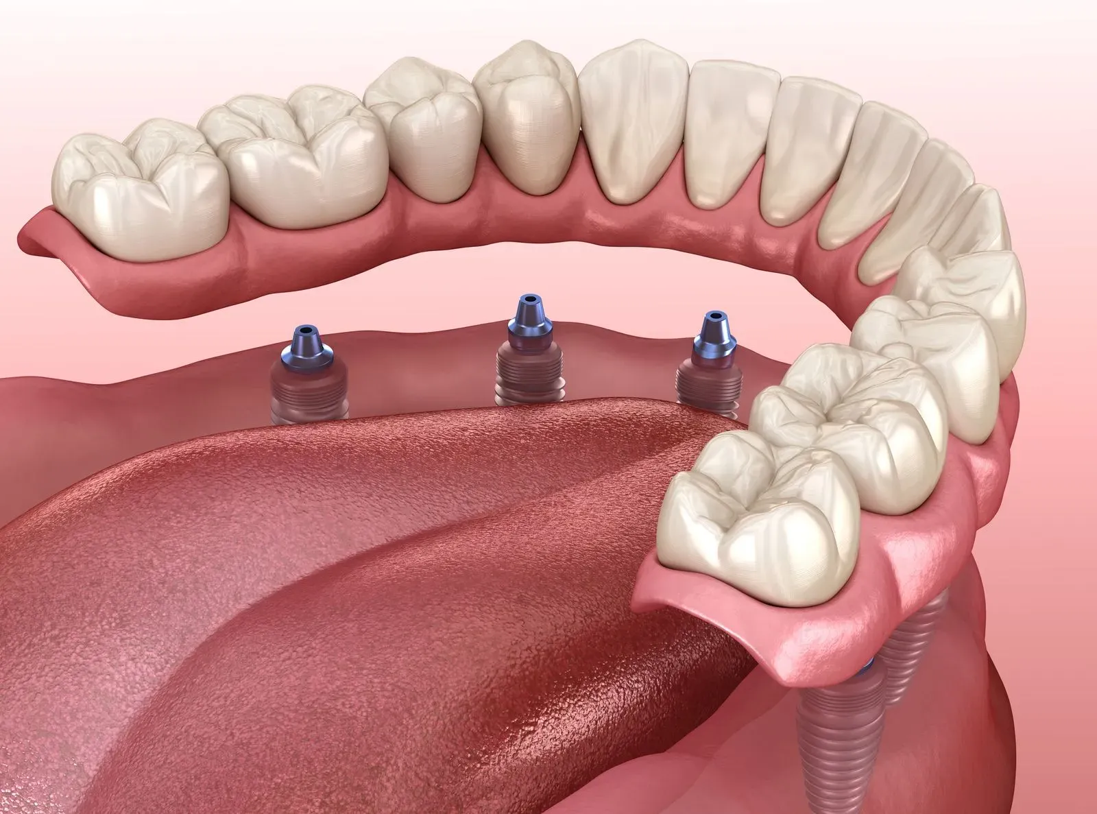 Rediscover Your Smile with All-on-X Implants: A Comprehensive Guide