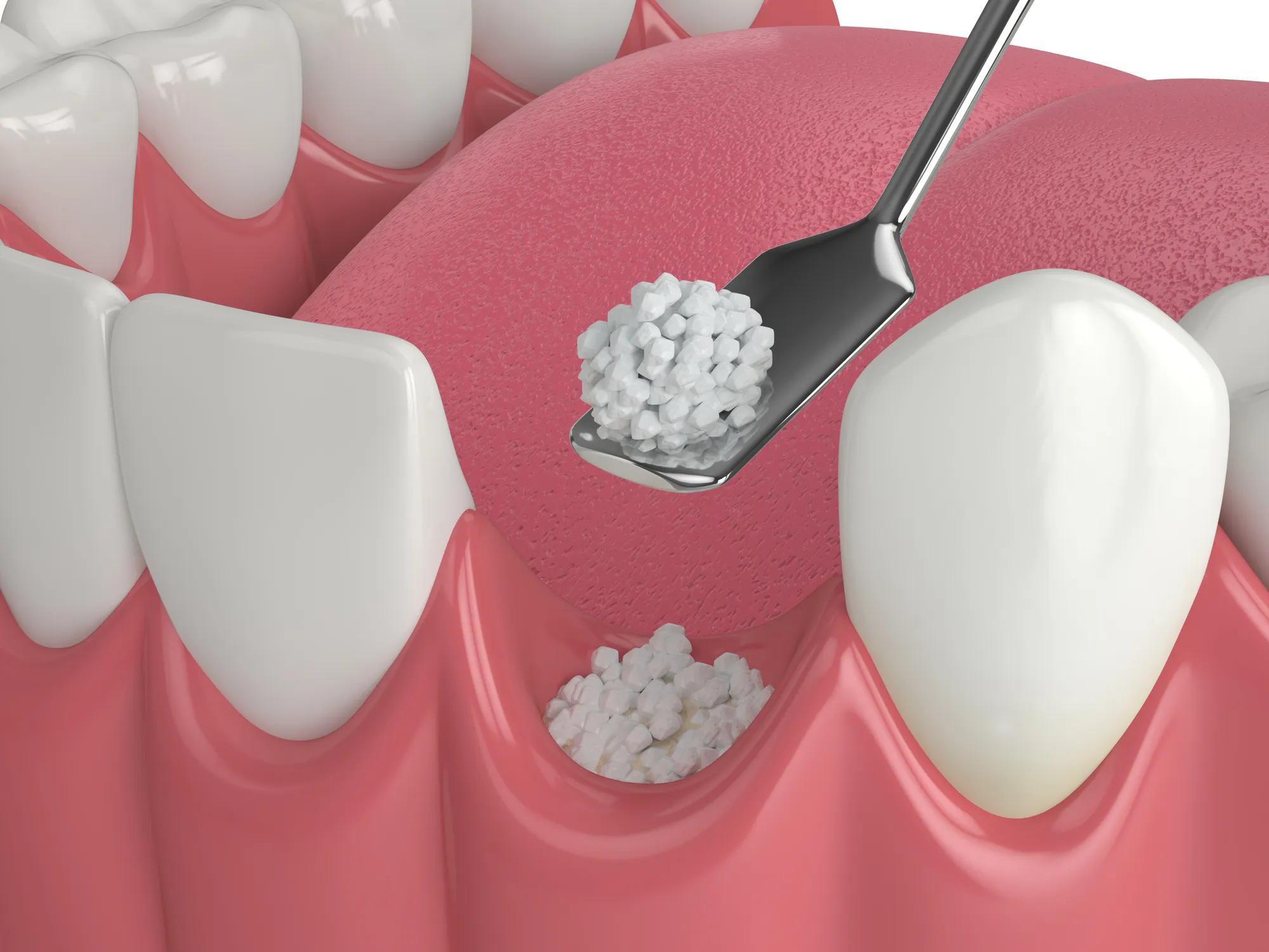 Everything You Need to Know About Bone Grafting in Dentistry
