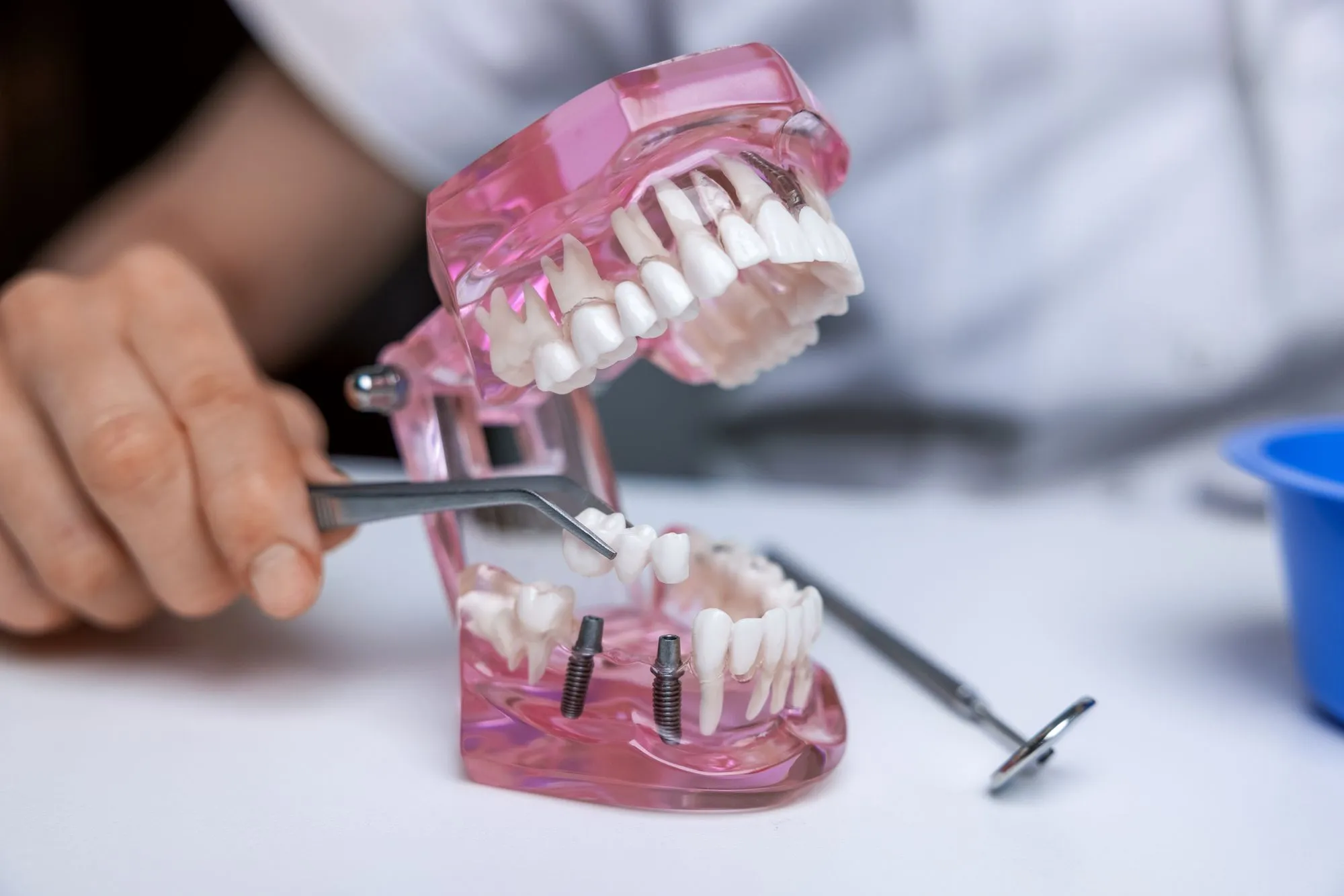 Restoring Your Smile: Everything You Need to Know About Dental Bridges