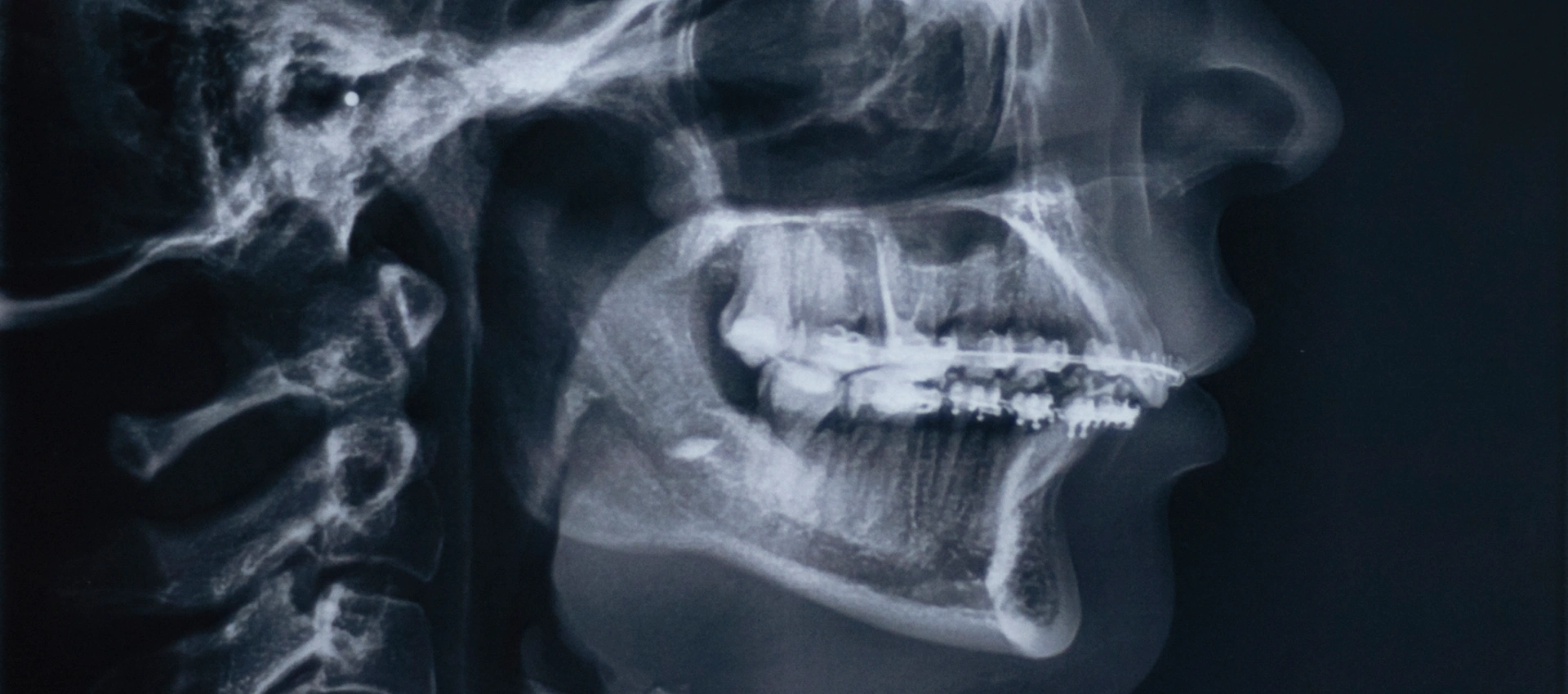 Cephalometric X-rays