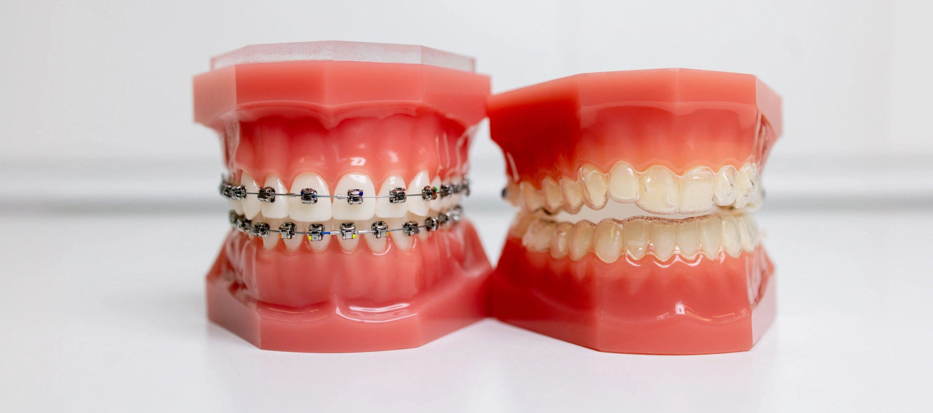 Clear Aligners vs. Traditional Braces: Which is Right for You?
