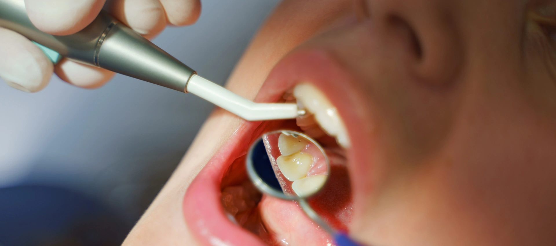 Fluorescence Caries Detection Devices Like DIAGNOdent