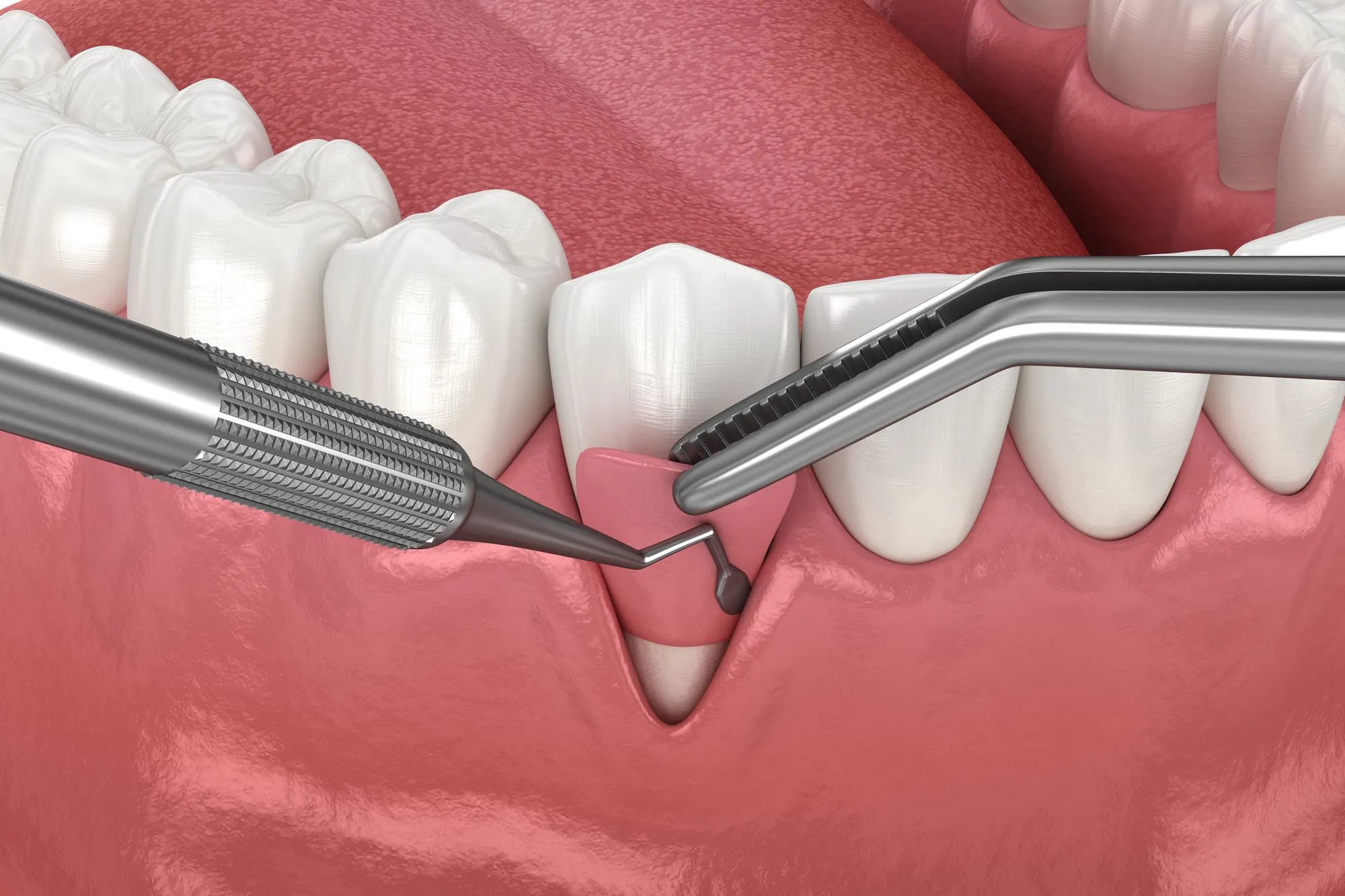 Restoring Your Smile: An In-Depth Guide to Gum Grafting