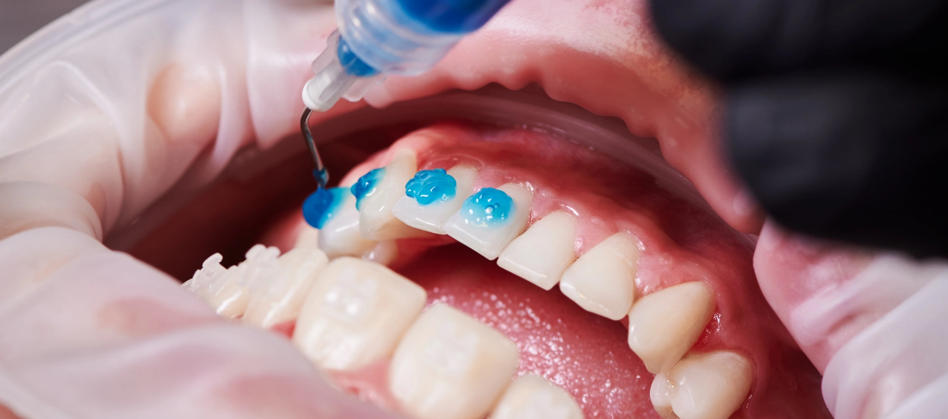 Unlocking Smiles Early: The Revolutionary Icon Procedure for Early-Stage Caries