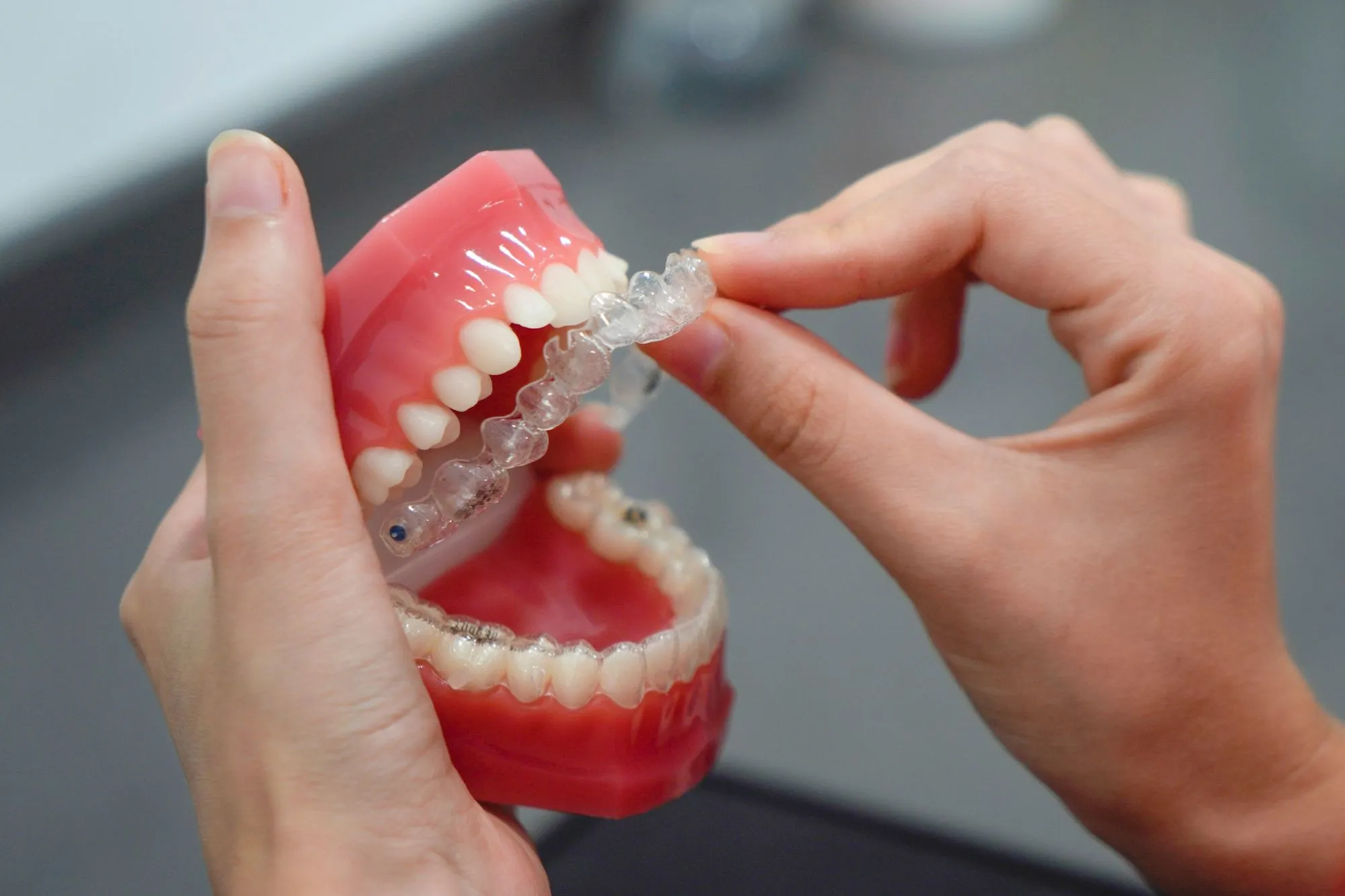 Transforming Your Smile with Invisalign/Clear Aligners