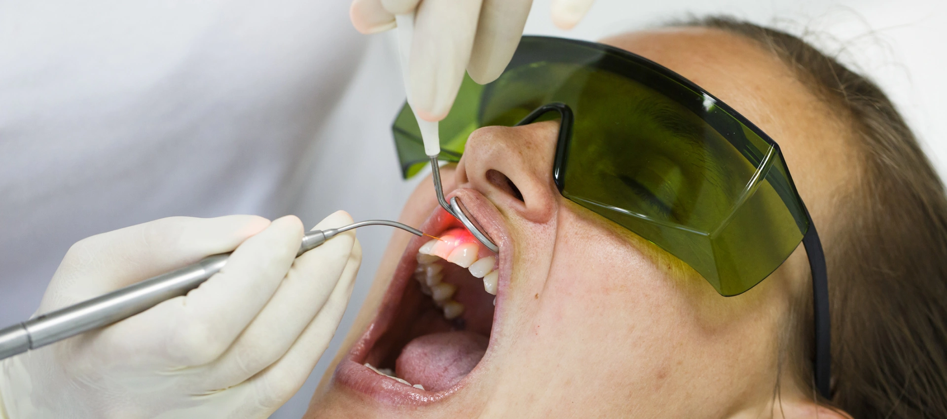 LANAP Laser Treatment for Periodontal Therapy