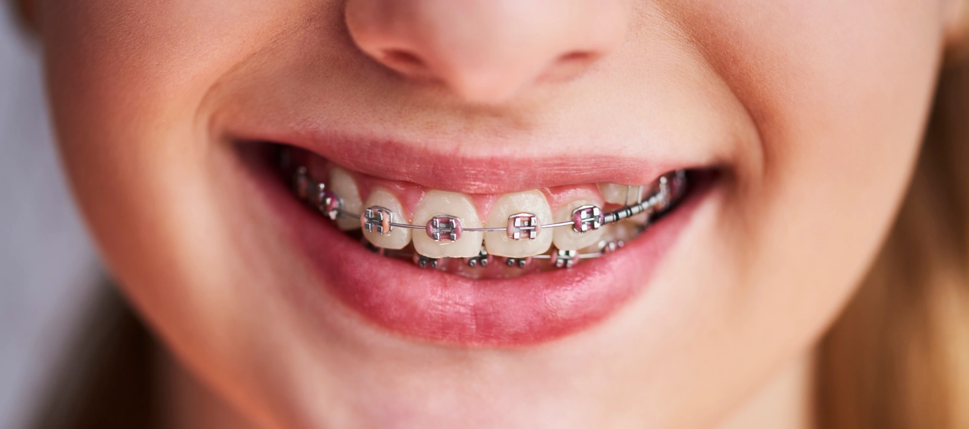 The Ultimate Guide to Orthodontics: Transforming Smiles, Enhancing Lives