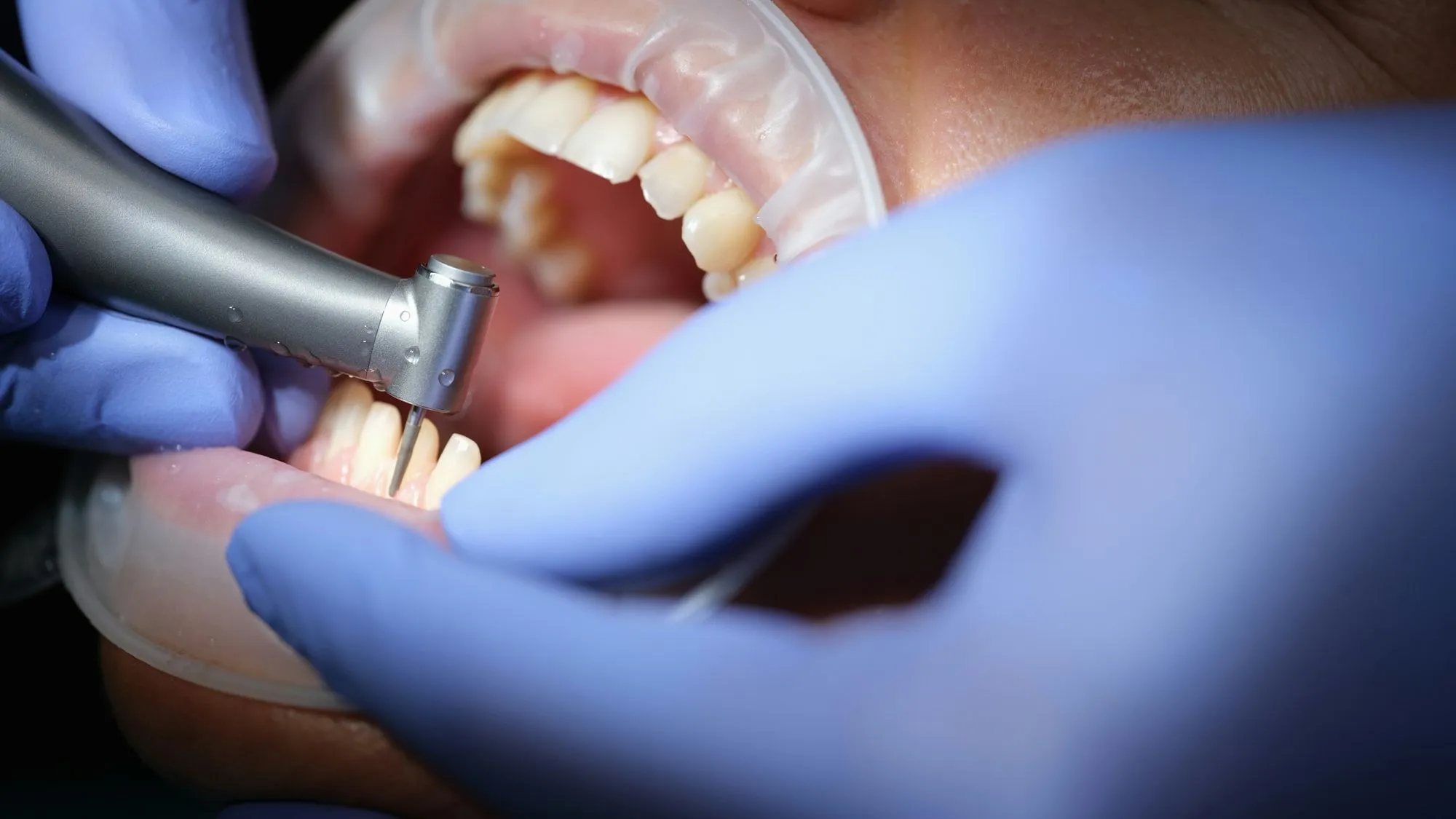 Restorative Dentistry: Restoring Your Smile and Enhancing Oral Health