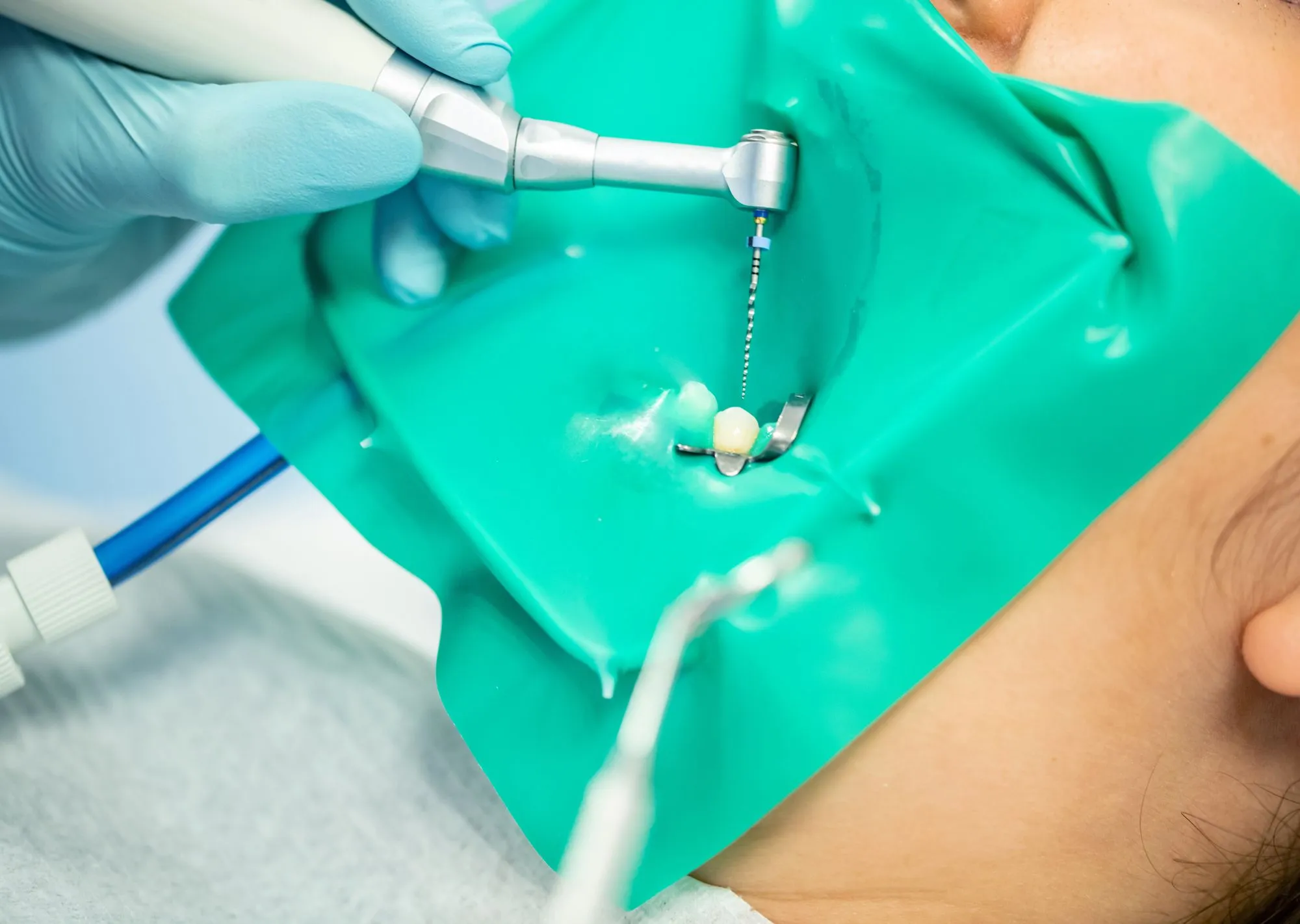 Understanding Root Canal Therapy: Saving Your Smile from the Inside Out